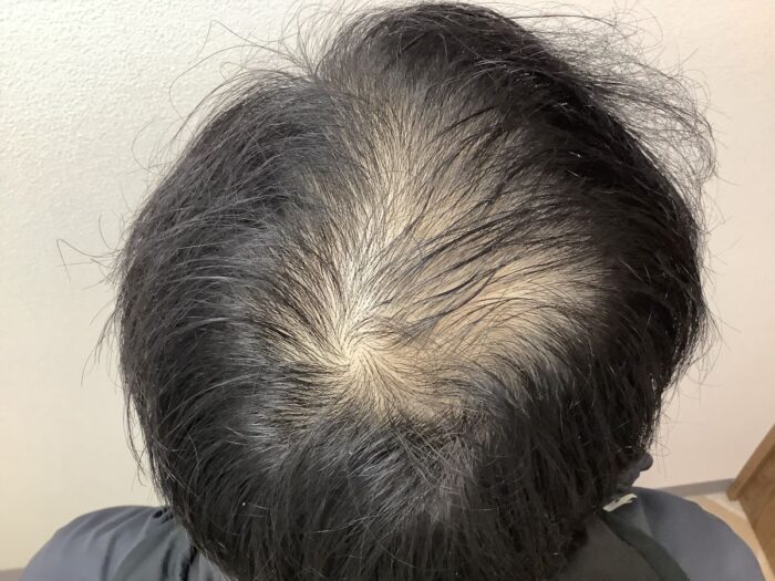 【32歳男性】生え際・頭頂部の薄毛がAGA治療で改善｜広島院