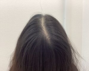 AGA治療前　20歳女性　生え際・頭頂部薄毛　新潟院