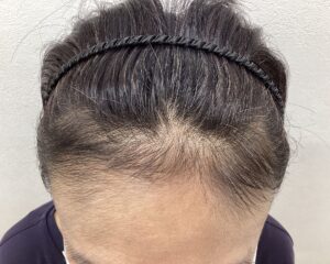 FAGA治療8ヵ月目　49歳女性　生え際薄毛　横浜院