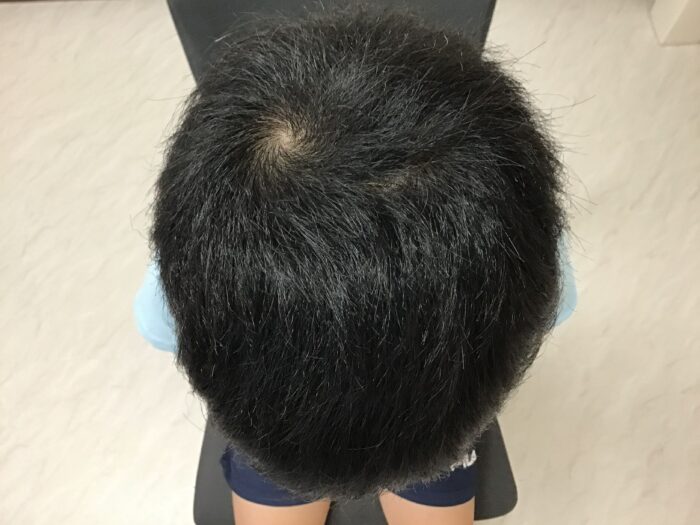 円形脱毛症治療開始1年2ヶ月後　5歳男児　汎発型　鹿児島院