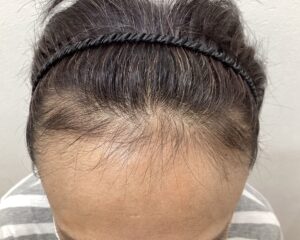 FAGA治療前　49歳女性　生え際薄毛　横浜院
