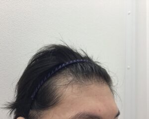 AGA治療前 43歳男性 生え際薄毛 新潟院