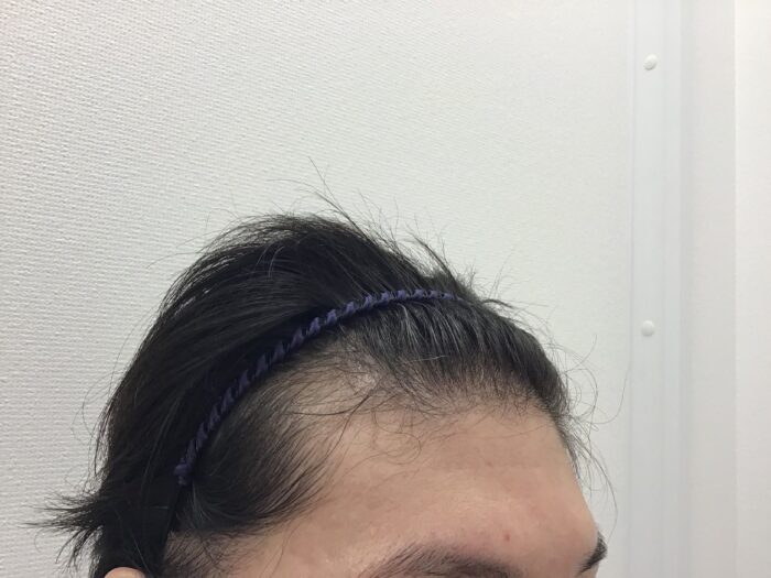 【43歳男性】生え際の薄毛がAGA治療で改善｜新潟院