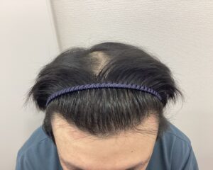 AGA治療前　28歳男性　前頭部薄毛　新潟院