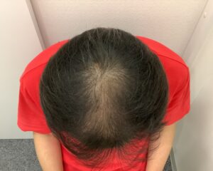 AGA治療前　59歳男性　頭頂部薄毛　新潟院