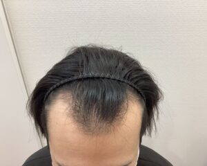 AGA治療前　26歳男性　前頭・頭頂部薄毛　新潟院