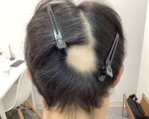 AGA・円形脱毛症治療前　33歳男性　生え際の薄毛　新潟院