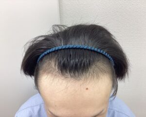 AGA治療前　27歳男性　生え際薄毛　新潟院