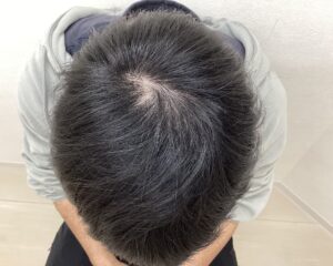 AGA治療後　26歳男性　頭頂部薄毛　横浜院