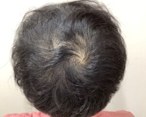 AGA治療後＿30歳男性＿生え際・頭頂部の改善＿広島院