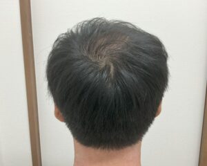 AGA治療後_29歳男性_生え際・頭頂部の改善_広島院