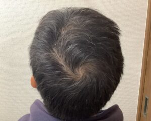 AGA治療後＿４９歳男性＿頭頂部の薄毛改善＿広島院