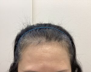 FAGA治療前　57歳女性　生え際・分け目薄毛　新潟院