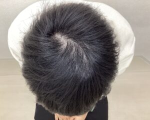 AGA治療3ヵ月目　26歳男性　頭頂部薄毛　横浜院