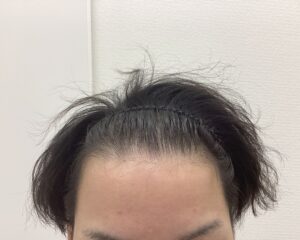 AGA治療前 25歳男性 前頭・頭頂部薄毛 新潟院