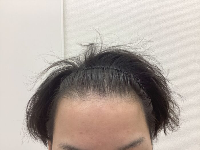 【25歳男性】前頭・頭頂部の薄毛がAGA治療で改善｜新潟院
