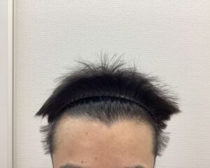 AGA治療前　44歳男性　生え際・頭頂部薄毛　新潟院