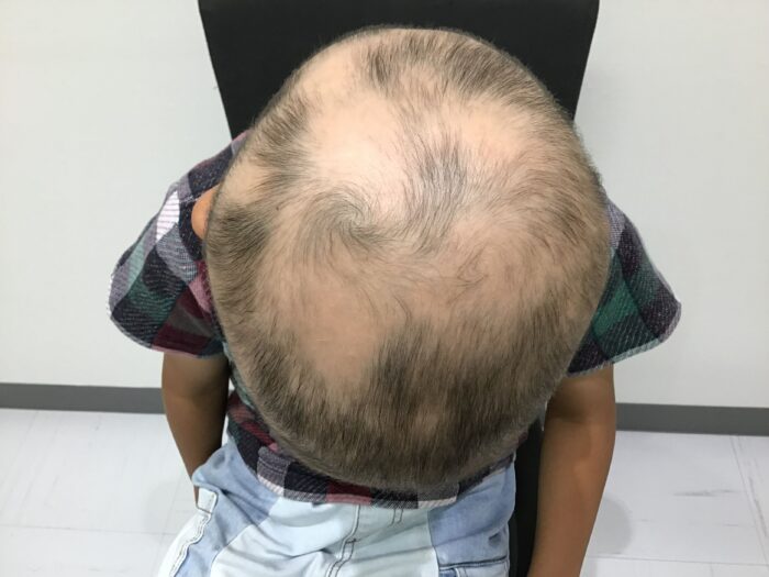 円形脱毛症治療開始2ヶ月後　5歳男児　汎発型　鹿児島院