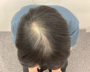 AGA治療前　28歳男性　頭頂部薄毛　新潟院
