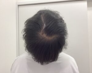 AGA治療前 25歳男性 前頭・頭頂部薄毛 新潟院
