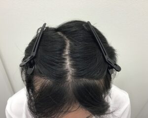 AGA治療前 43歳男性 生え際薄毛 新潟院