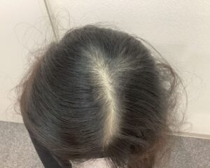 AGA治療前　20歳女性　生え際・頭頂部薄毛　新潟院