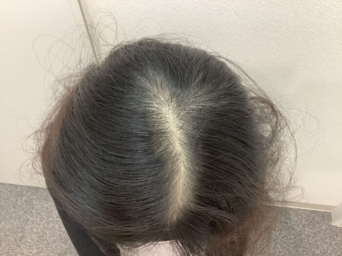 【20歳女性】生え際・頭頂部の薄毛がFAGA治療で改善｜新潟院