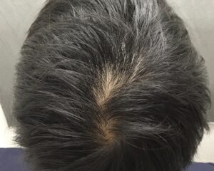 AGA治療前　34歳男性　頭頂部薄毛　京都院