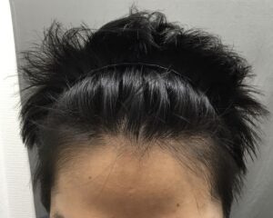 AGA治療7ヶ月後　34歳男性　生え際改善　京都院