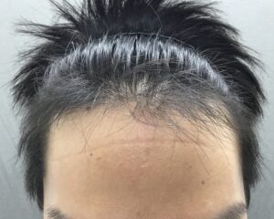 AGA治療前　34歳男性　生え際薄毛　京都院
