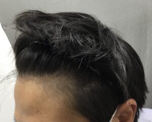 AGA治療14ヶ月後　34歳男性　生え際改善　京都院