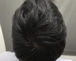 AGA治療14ヶ月後　34歳男性　頭頂部改善　京都院