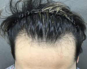 AGA治療前　31歳男性　生え際薄毛　京都院
