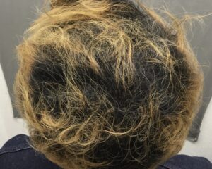 AGA治療4ヶ月後　31歳男性　頭頂改善　京都院