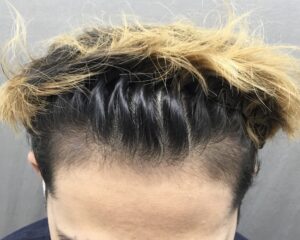 AGA治療4ヶ月後　31歳男性　生え際改善　京都院