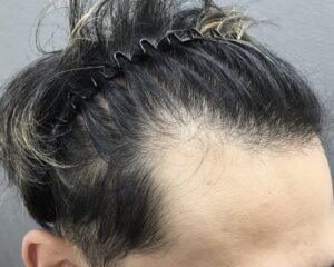 AGA治療前　31歳男性　生え際薄毛　京都院