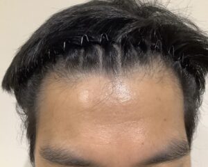 AGA治療後_27歳男性_生え際・頭頂部の改善_姫路院