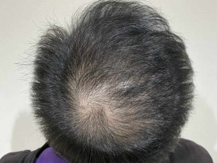 【27歳男性】生え際・頭頂部の薄毛がAGA治療で改善｜姫路院