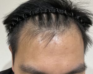 AGA治療前_27歳男性_生え際・頭頂部の薄毛_姫路院