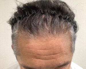 AGA治療6か月後　47歳男性　生え際改善　姫路院