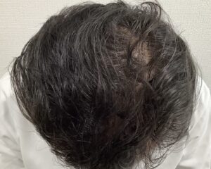 AGA治療6か月後　47歳男性　頭頂部改善　姫路院