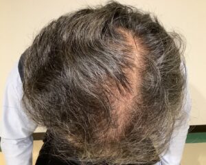 AGA治療前　47歳男性　頭頂部