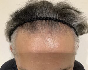 AGA治療前　47歳男性　生え際