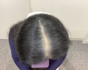 FAGA治療前　57歳女性　生え際・分け目薄毛　新潟院