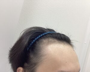 AGA治療前　27歳男性　生え際薄毛　新潟院