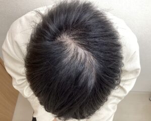 AGA治療前　26歳男性　頭頂部薄毛　横浜院