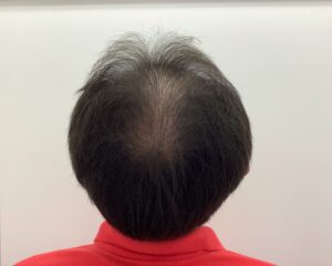AGA治療前　59歳男性　頭頂部薄毛　新潟院