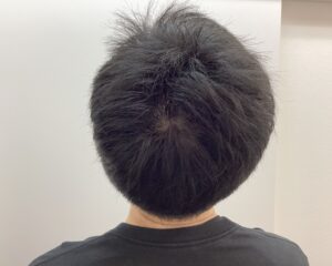 AGA治療前　44歳男性　生え際・頭頂部薄毛　新潟院