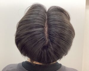 AGA治療前　27歳男性　生え際・頭頂部薄毛　新潟院