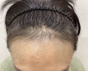 FAGA治療2ヵ月目　49歳女性　生え際薄毛　横浜院